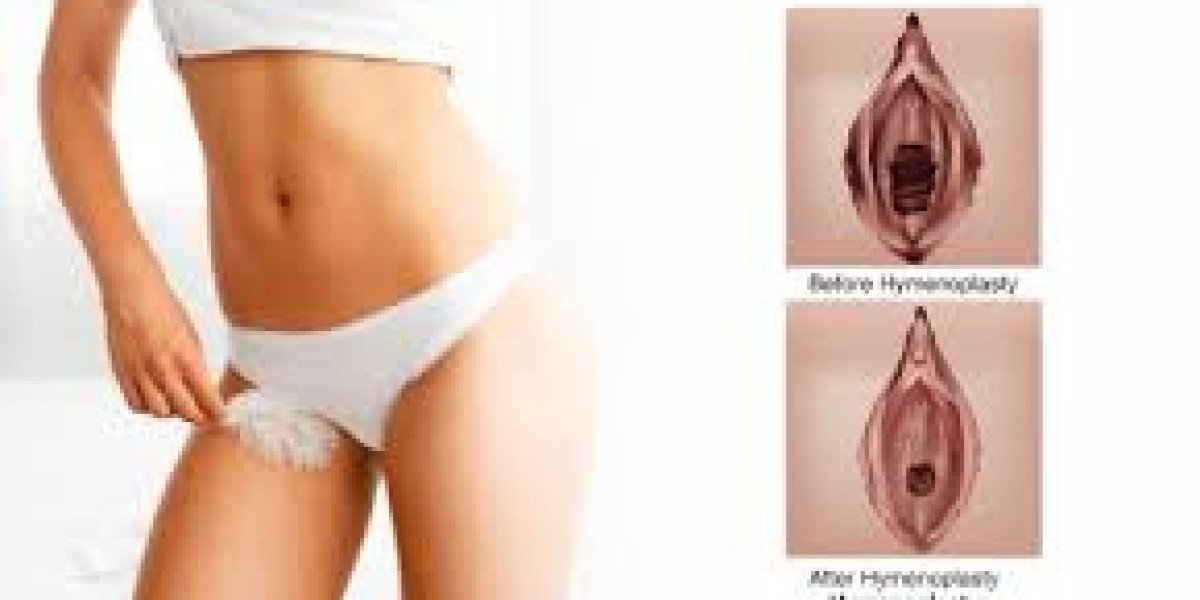 What To Know Before Undergoing Hymenoplasty Surgery?