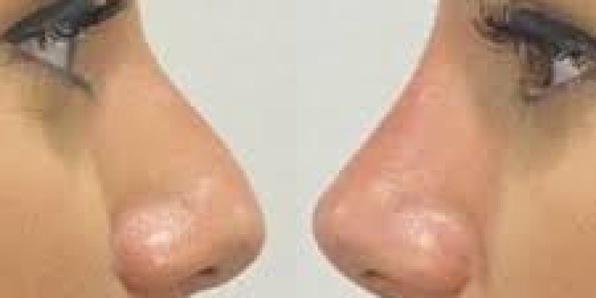 Affordable Nose Surgery in Pakistan Islamabad: Cost Breakdown & Patient Guide